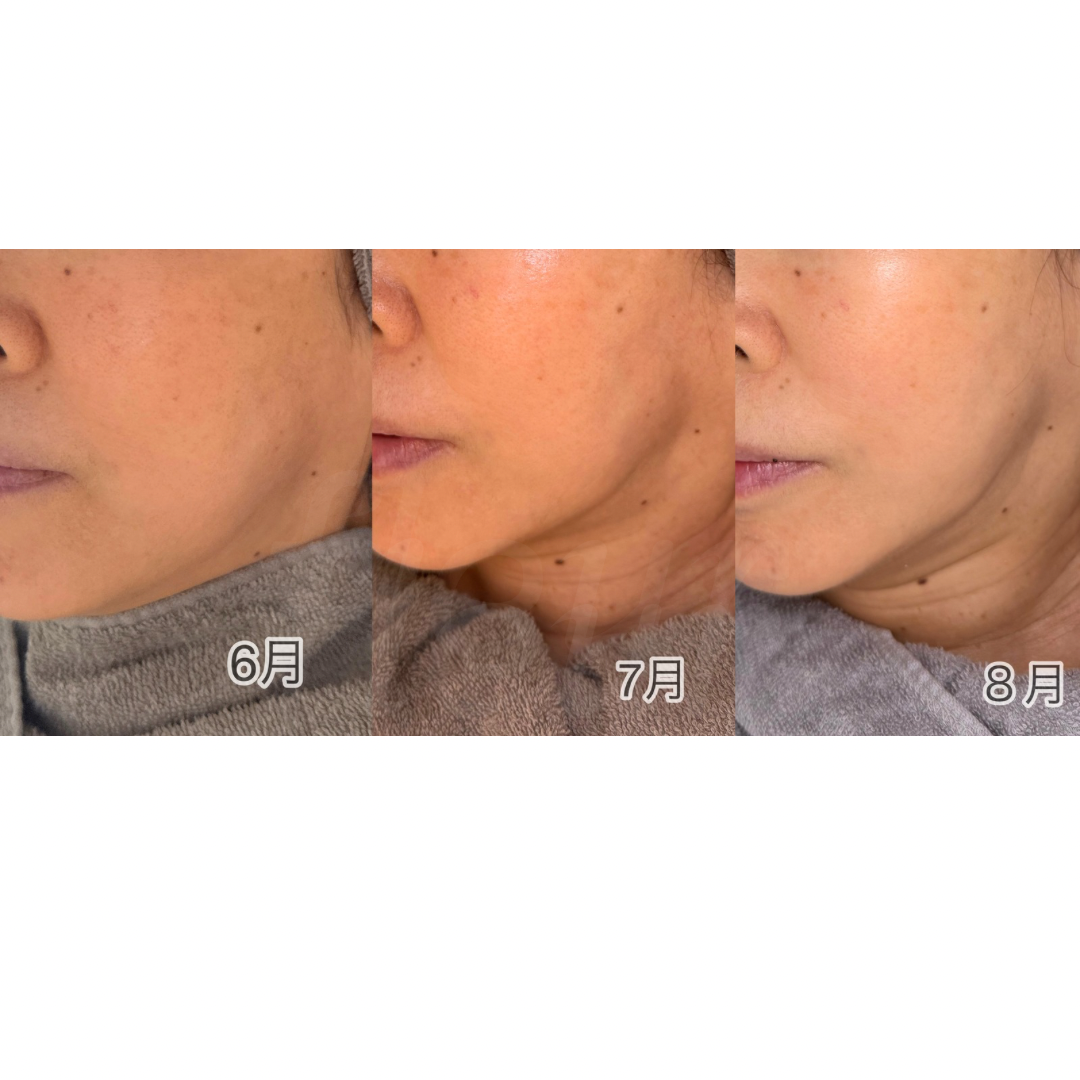 3週間に1度のペースで通われているお客様✨ フェイスラインが引き締まり、透明感もアップ。 プラズマリフトアップで“肌を育てるケア”を実感されています☺️の画像