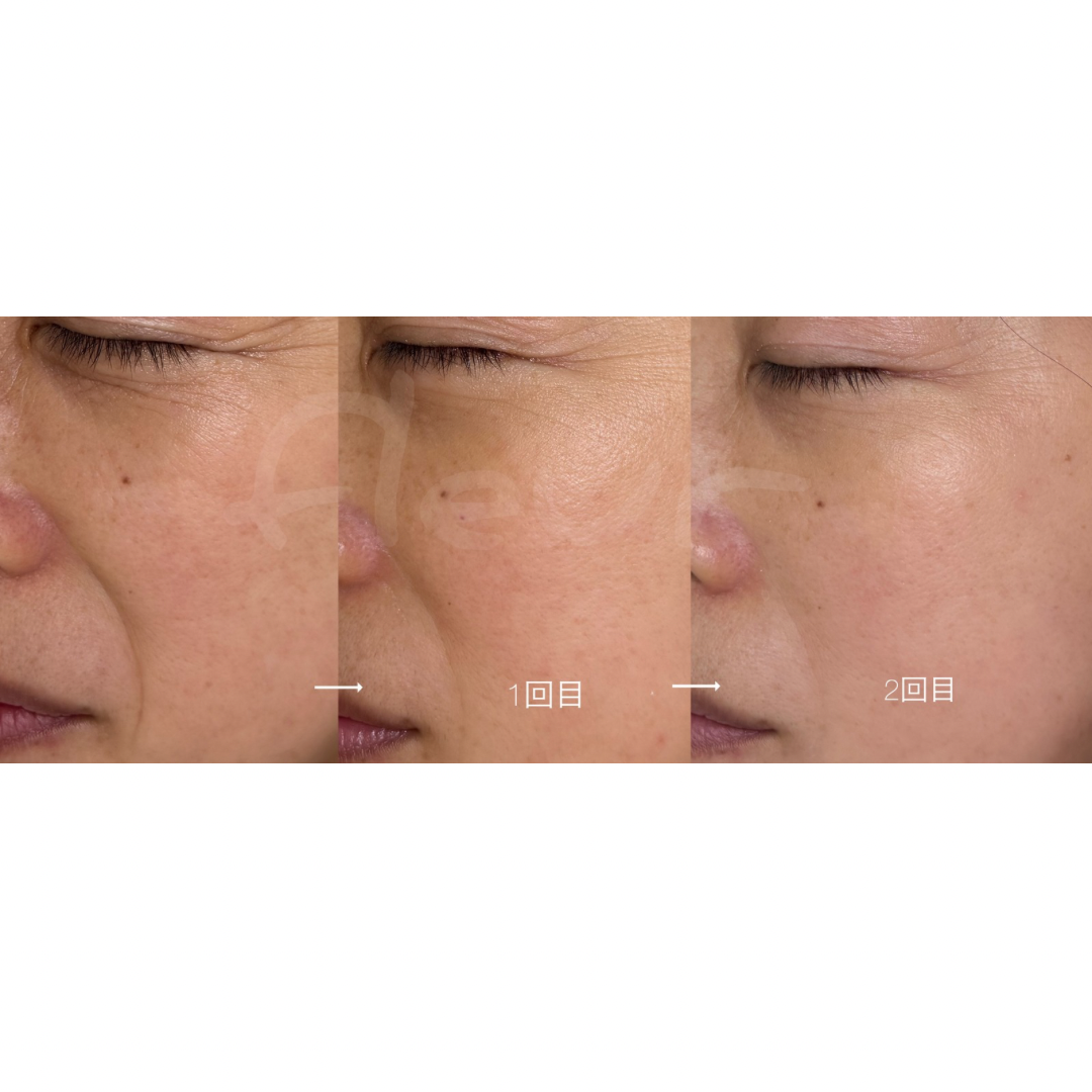 4週間に１回、通われているお客様。1回目から「肌が変わるのがわかる」✨ プラズマでお肌を整え、リンパを流して フェイスラインまでスッキリ。の画像